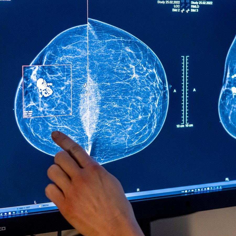 Mammografie-Screening künftig bereits ab 45 Jahren